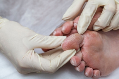 How Diabetes Can Affect Your Feet